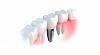 Установка зубных имплантатов под ключ в BrainMark Dental Studio